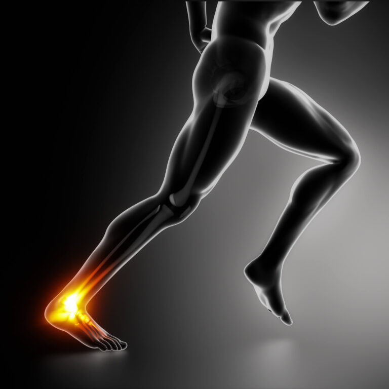 plantar fasciitis