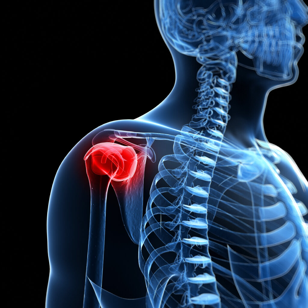 Techniques to Alleviate Pain in Our Shoulders