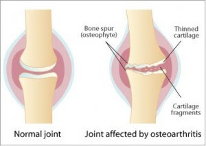 Inflammation of Our Joints