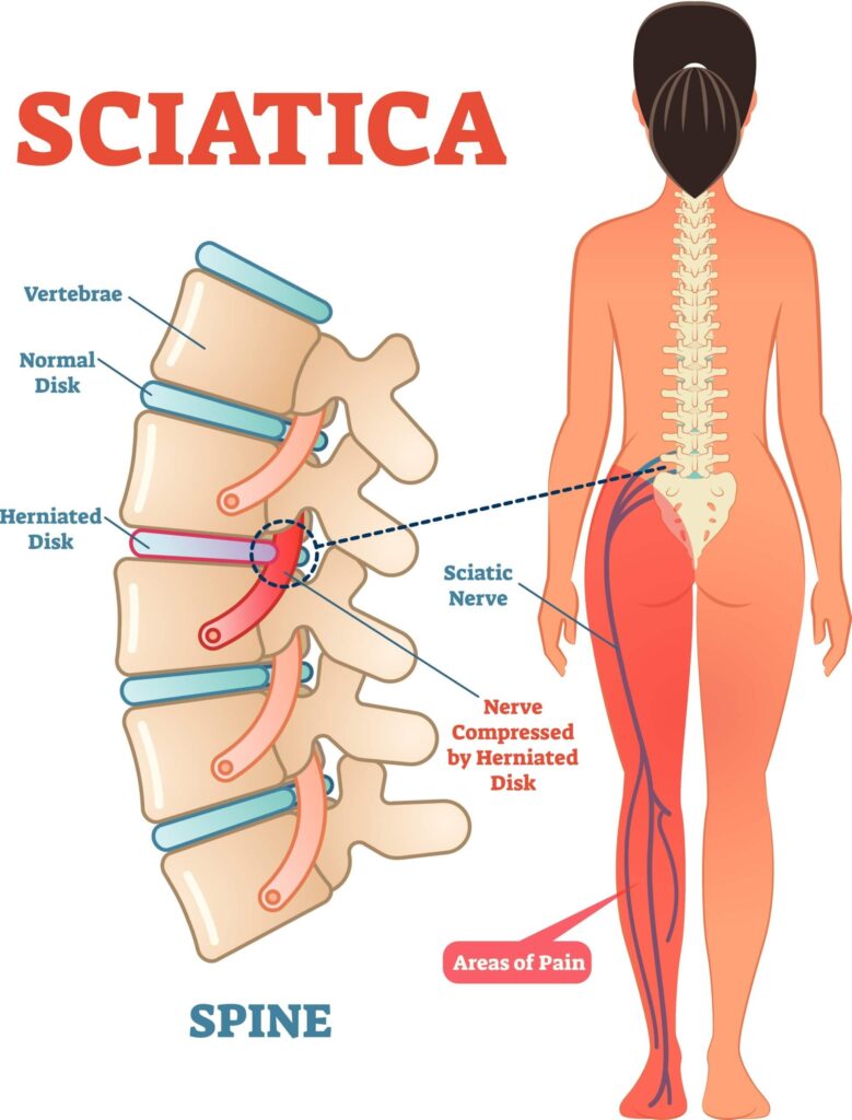 Sciatica: Discomfort in Our Backside