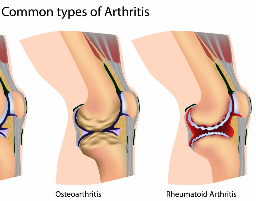 Osteoarthritis VS Rheumatoid Arthritis
