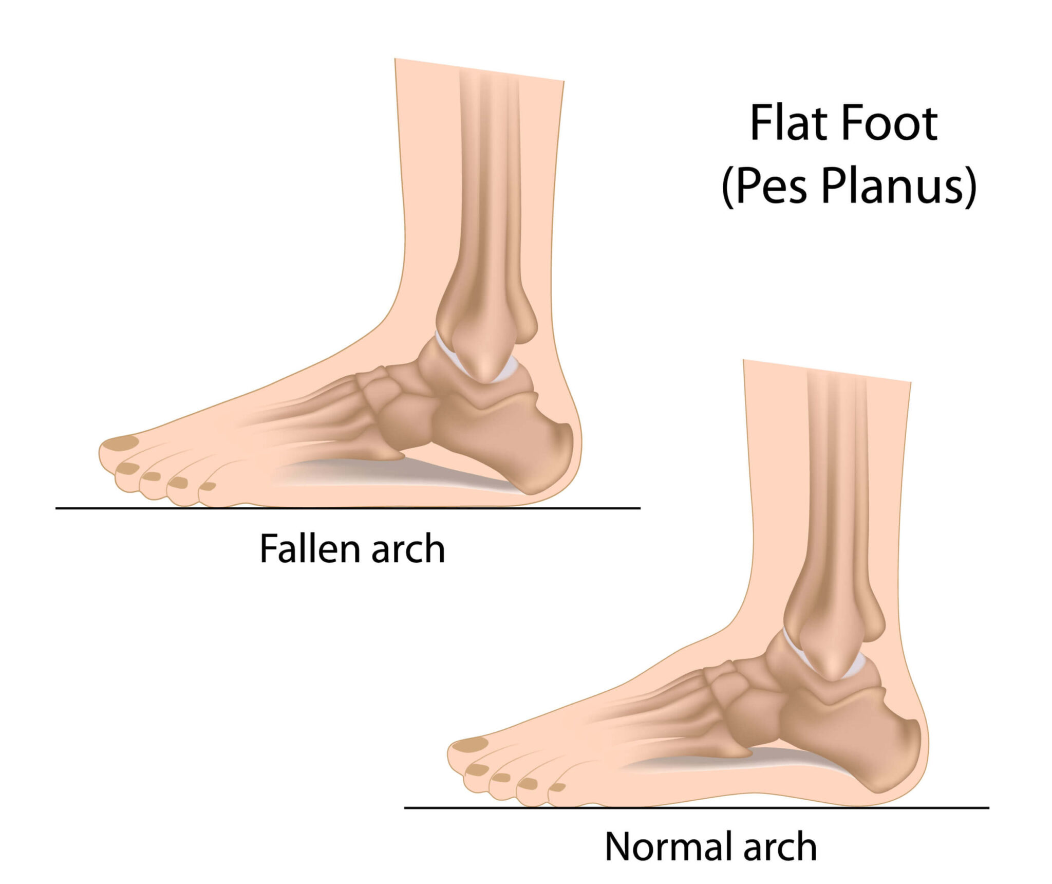 Fallen Arches & Foot Issues - Physical Therapy, Sterling, VA