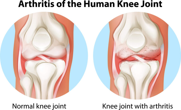 osteoarthritis