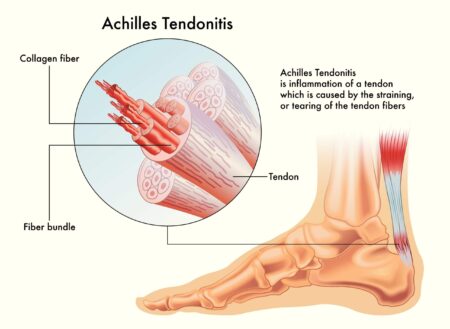 How to Treat Achilles Tendinopathy — Base Camp Chiropractic & Sports Rehab