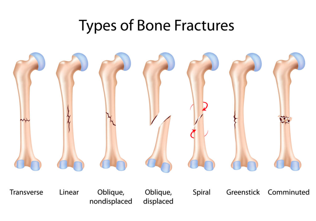 Shoulder Fractures
