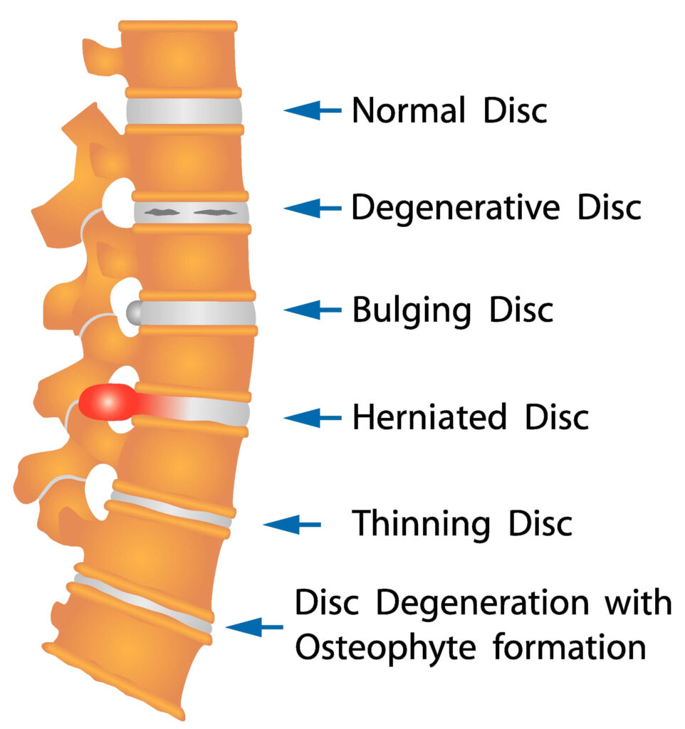 Herniated and Bulging Discs: Symptoms to Look For