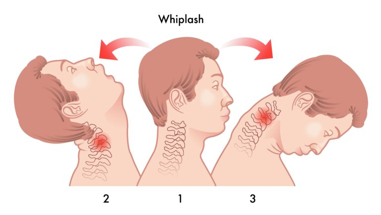 whiplash loudoun sports physical therapy