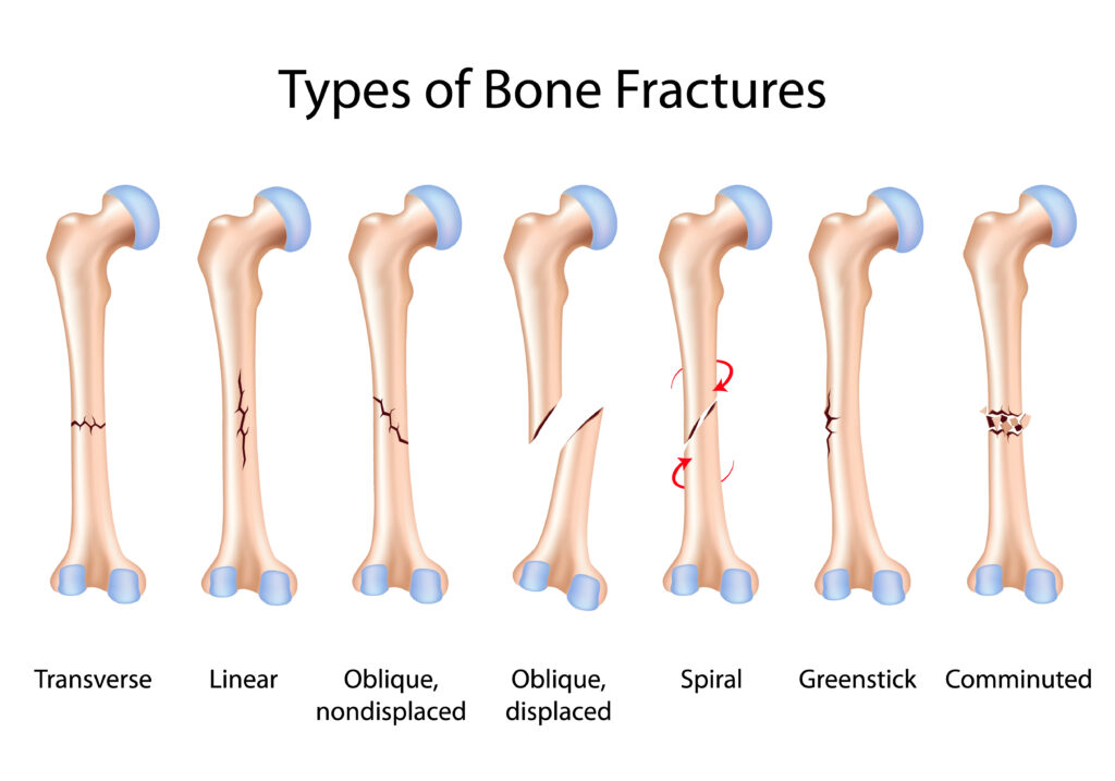 What is a Fracture?