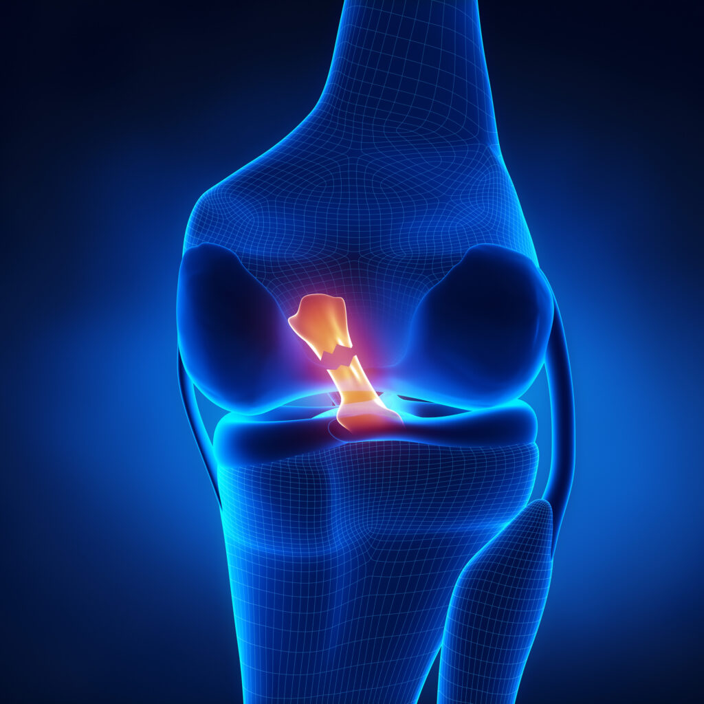 All You Need to Know About ACL Injuries!