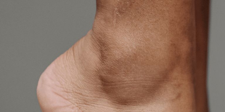 Achilles Tendinitis